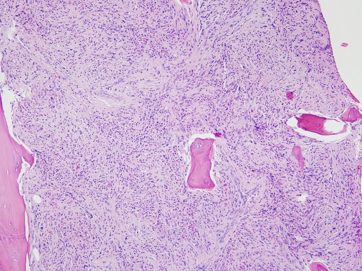 Bone marrow from 2008 (submitted glass slides). Osteomyelosclerotic bone marrow. Note markedly decreased erythropoiesis and few megakaryocytes. 